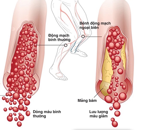 BỆNH XƠ VỮA ĐỘNG MẠCH VÀ NHỮNG ĐIỀU CẦN BIẾT