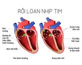 RỐI LOẠN NHỊP TIM – NGUYÊN NHÂN CỦA 80% TRƯỜNG HỢP ĐỘT TỬ