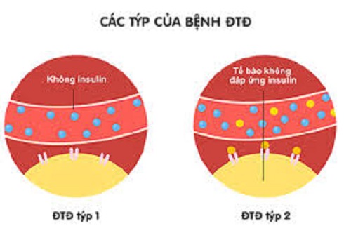 Tại sao những người mắc cả bệnh tiểu đường Loại 1 và Loại 2 dễ bị sâu răng(?)