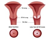 Thuốc điều trị ung thư cổ tử cung